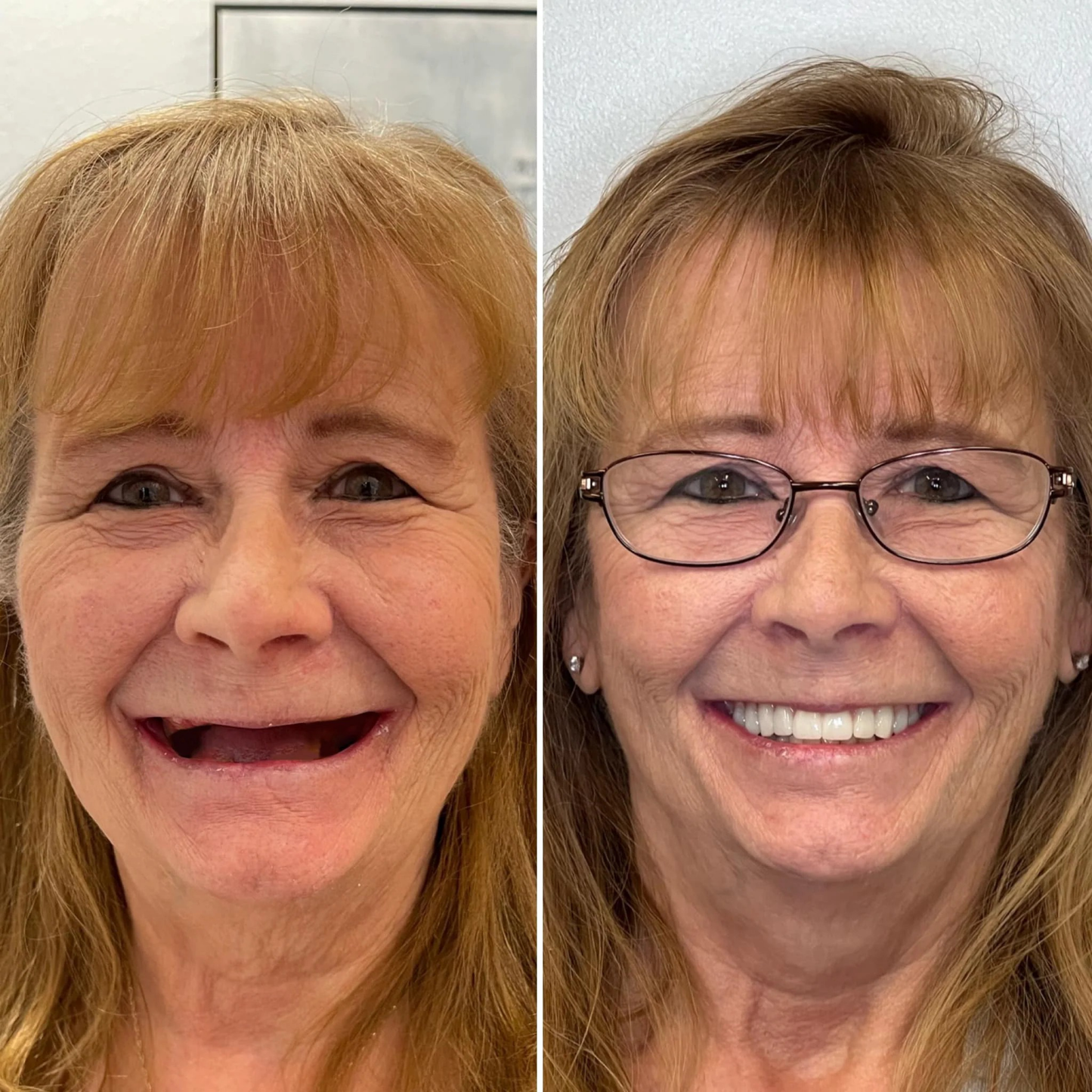 SmileSeal™- Because your smile deserves security.