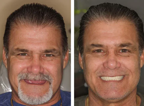 SmileSeal™- Because your smile deserves security.