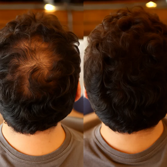 Rootiva™- Instantly Fuller Hair, Right at the Root.